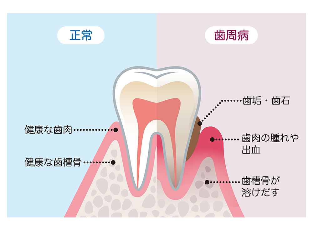 歯周病のイラスト