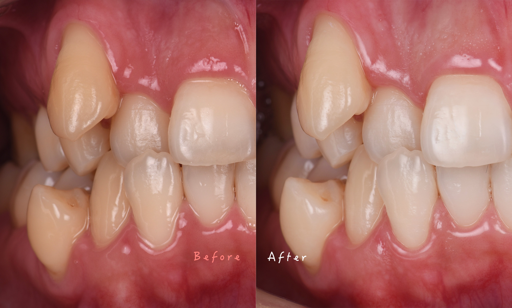 ホワイトニング